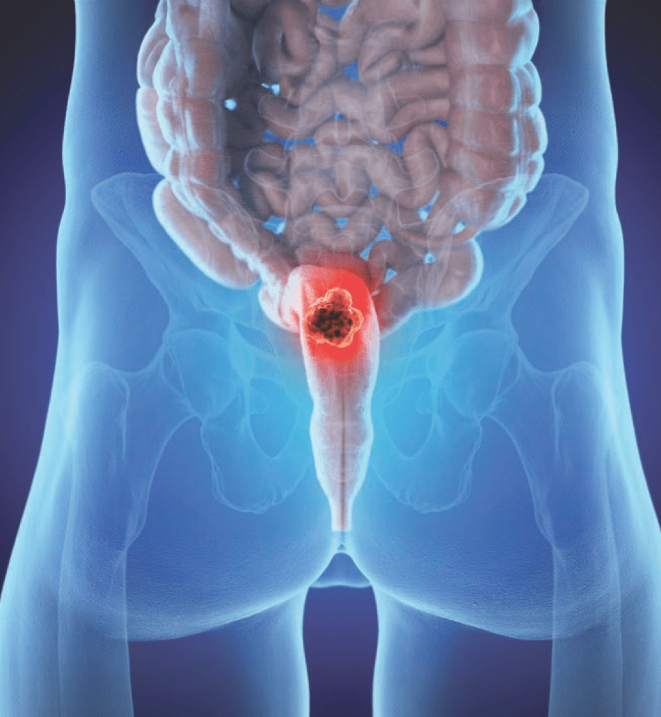 Rectal cancer project